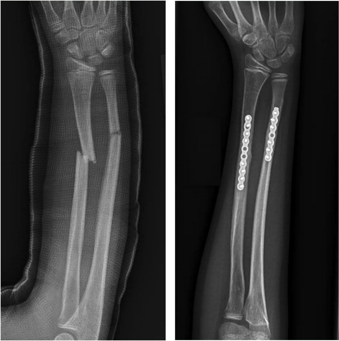 Fractured forearm deals